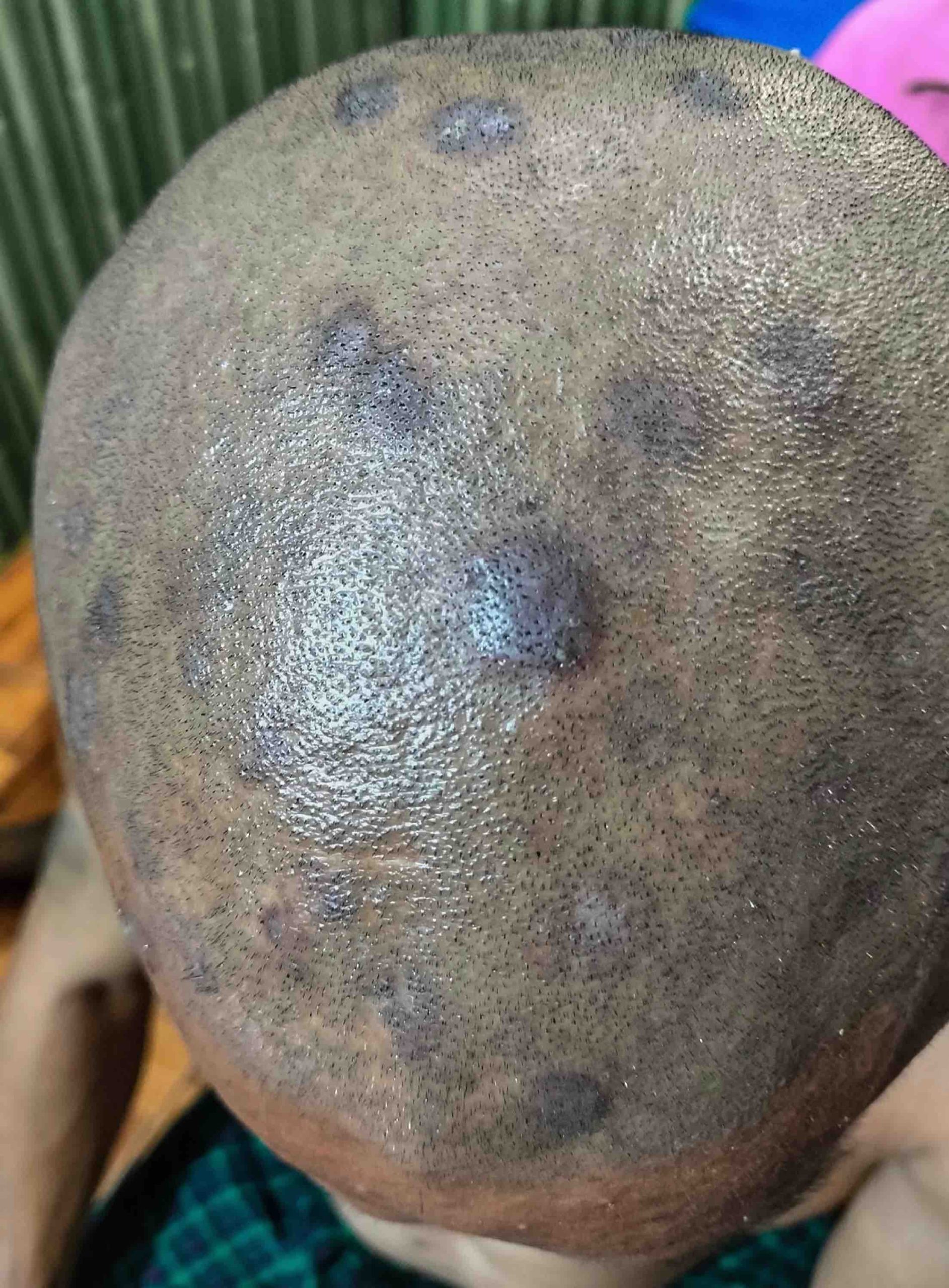 dermatofitosi